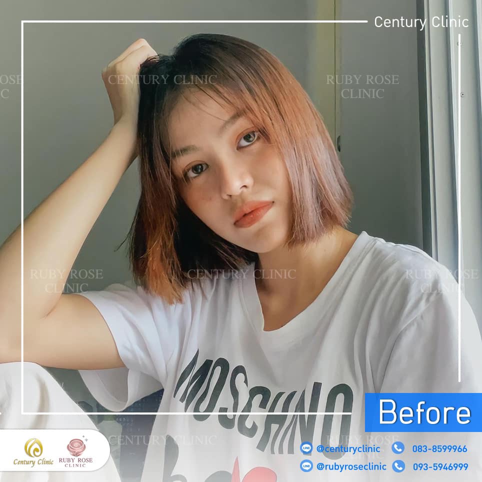 Century-รีวิว-แก้จมูก 2#338