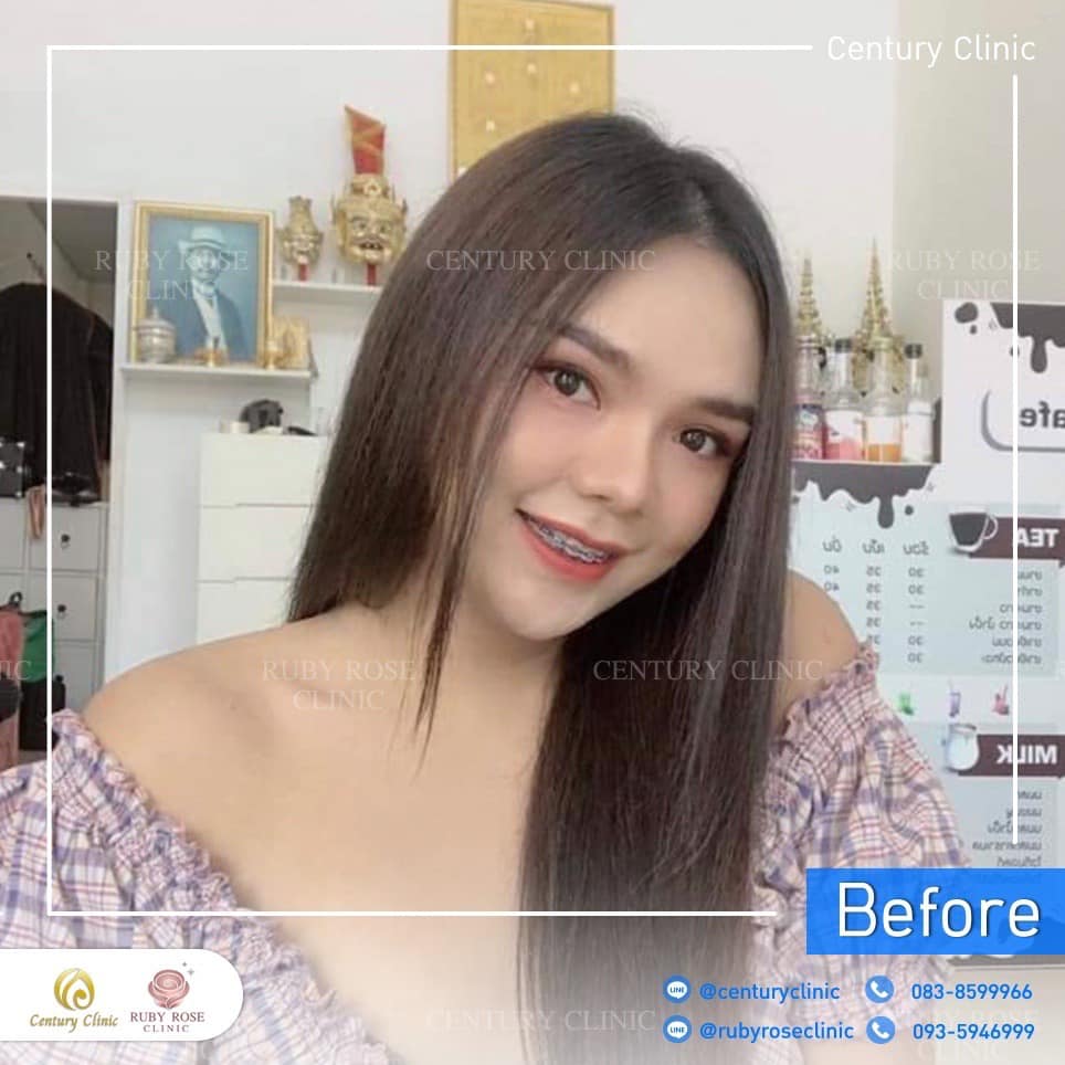 Century-รีวิว-แก้จมูก 2#342