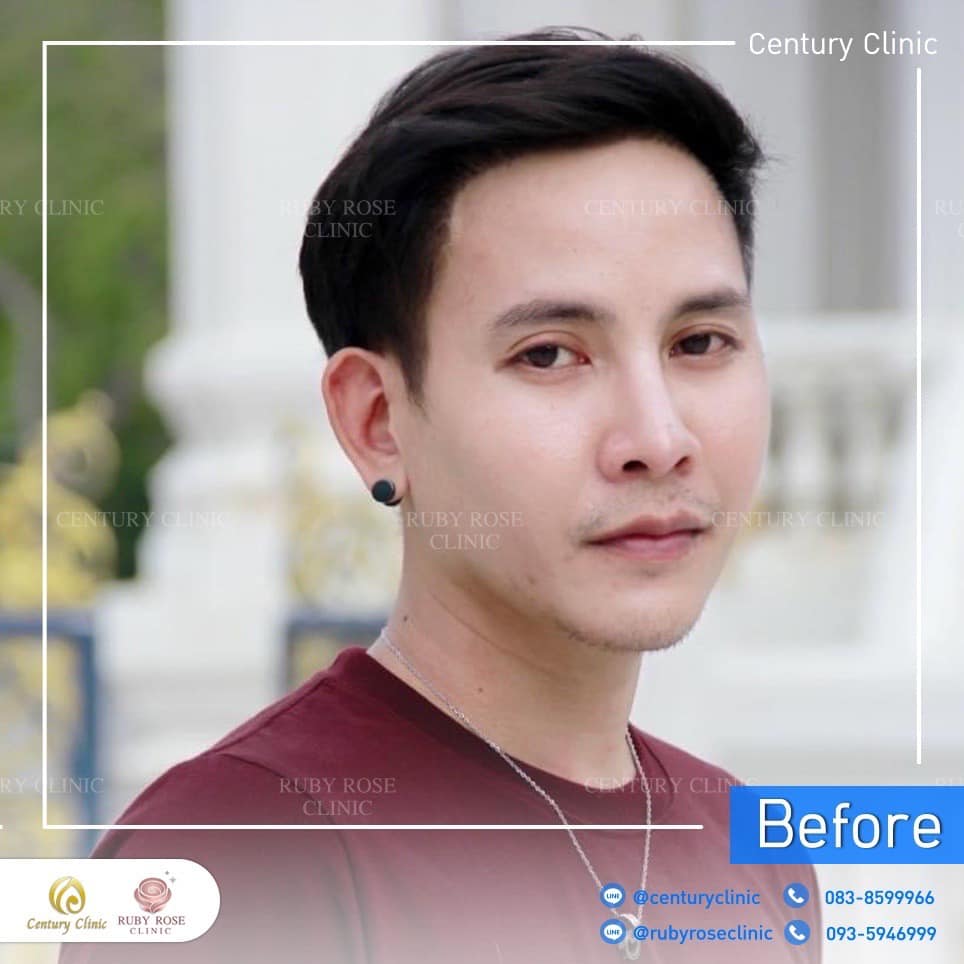 รีวิว แก้จมูก #346 , Century Clinic Thailand Century-รีวิว-แก้จมูก 2#346