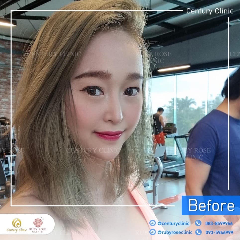 รีวิว แก้จมูก #352 , Century Clinic Thailand Century-รีวิว-แก้จมูก 2#352