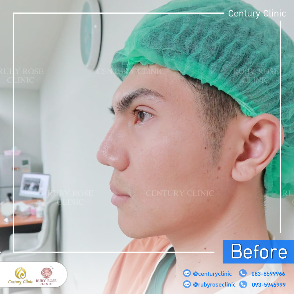 รีวิว แก้จมูก #353 , Century Clinic Thailand Century-รีวิว-แก้จมูก 2#353