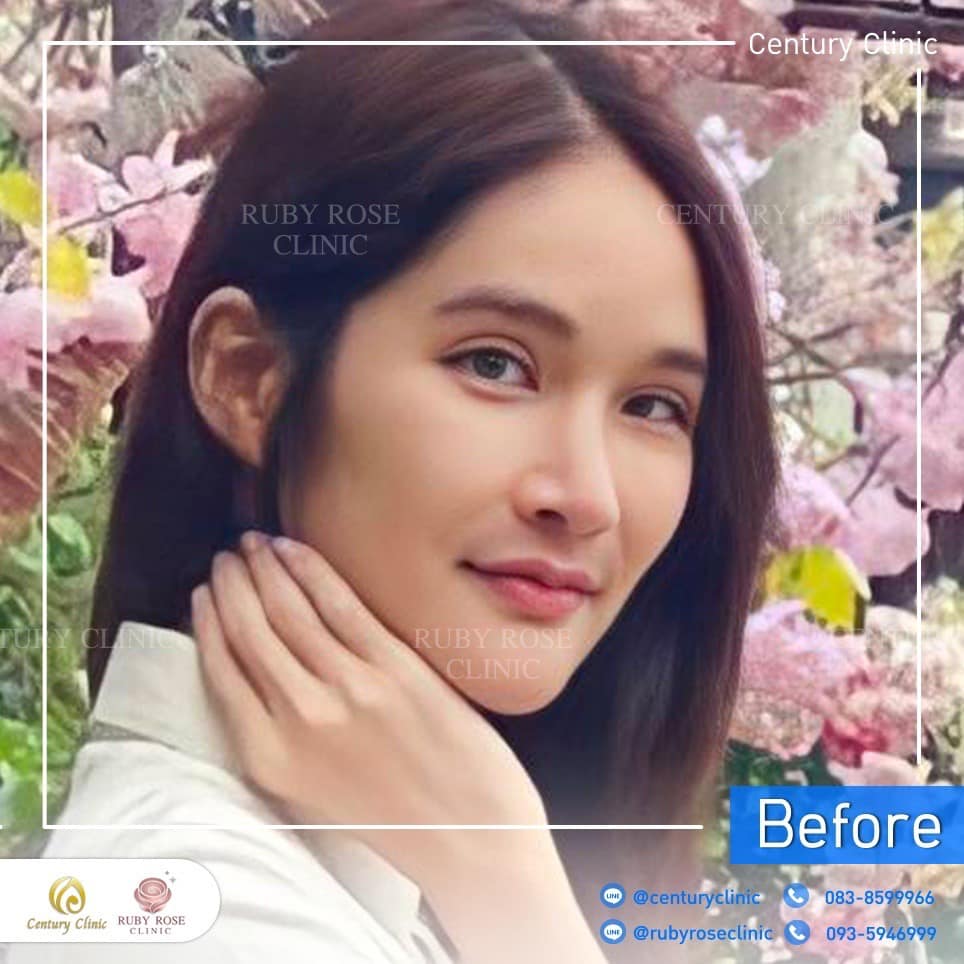 รีวิว แก้จมูก #358 , Century Clinic Thailand Century-รีวิว-แก้จมูก 2#358