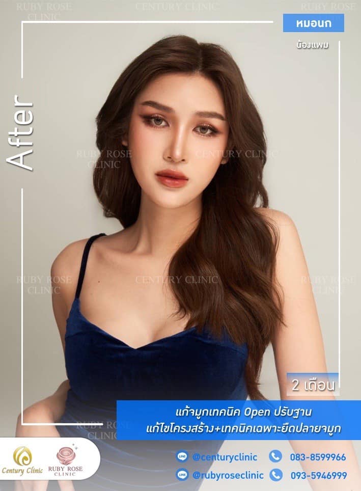 Century รีวิว แก้จมูก 1#276
