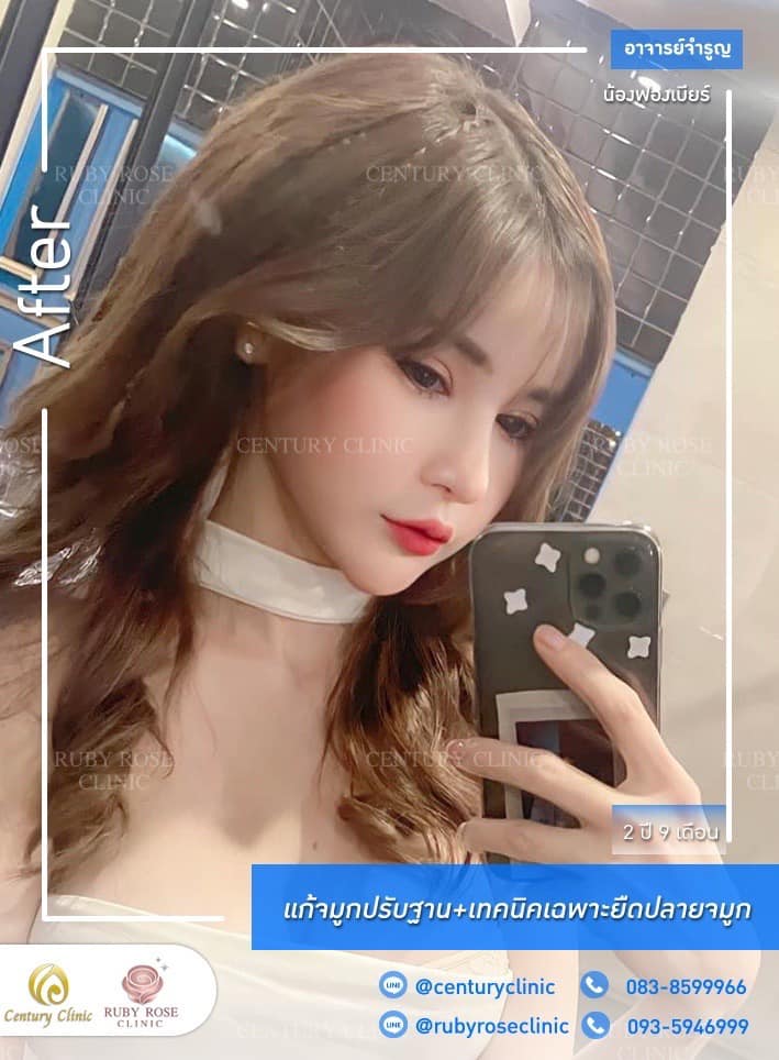 Century รีวิว แก้จมูก #277