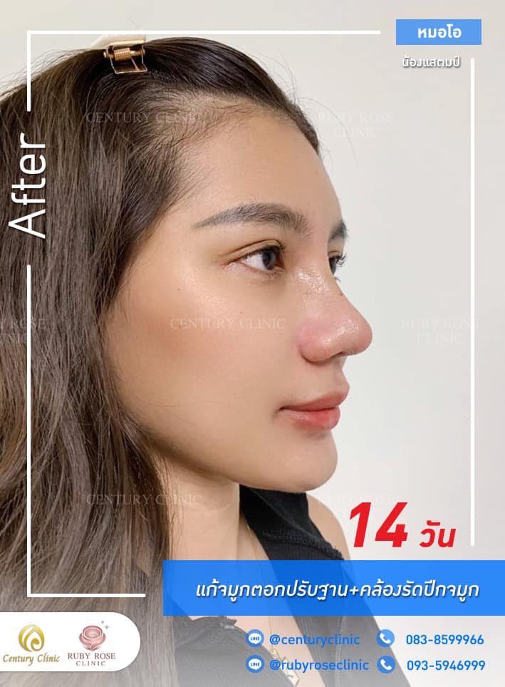 Century รีวิว แก้จมูก #285