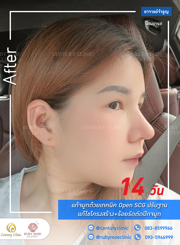 Century รีวิว แก้จมูก #286