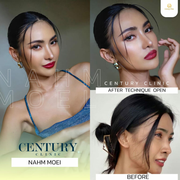 Century รีวิว แก้จมูก #287