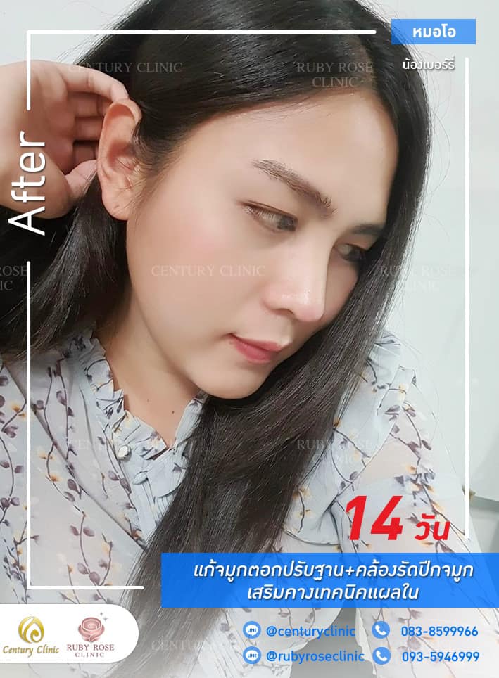 Century-รีวิว-แก้จมูก #291