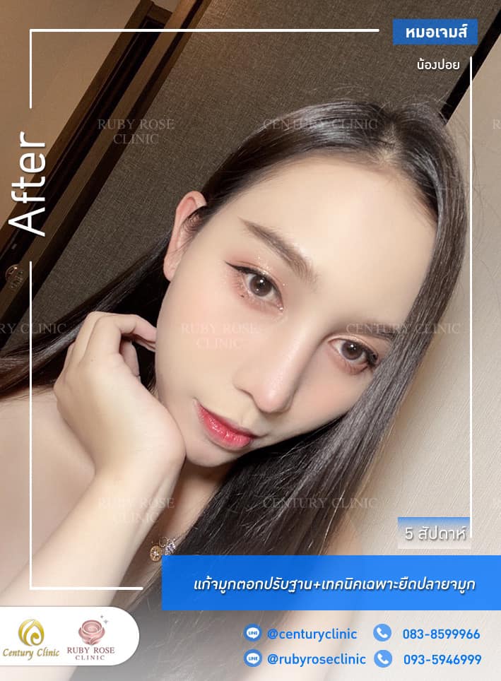 Century-รีวิว-แก้จมูก #292