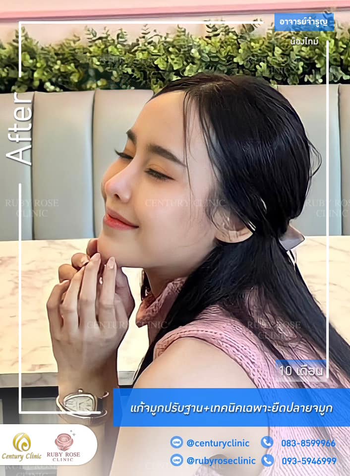 Century-รีวิว-แก้จมูก #293