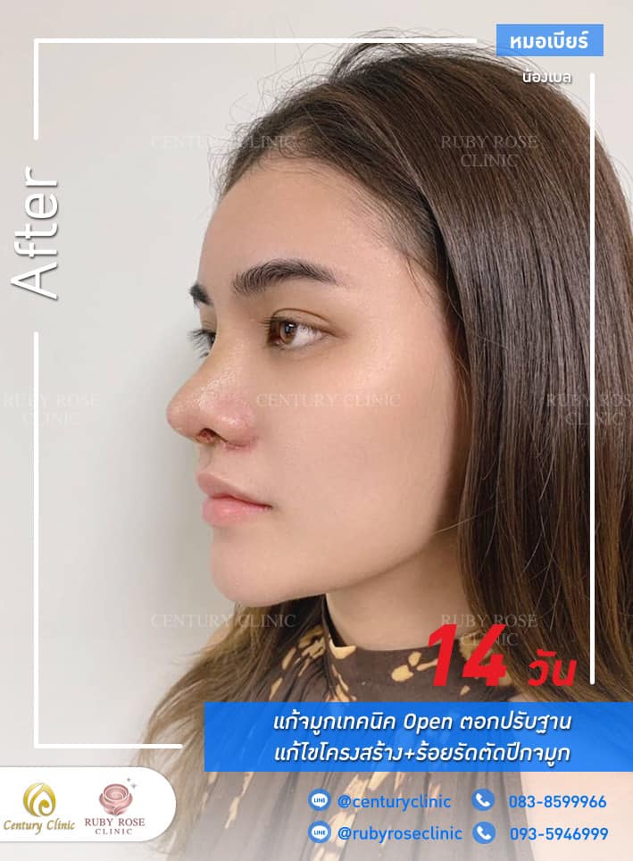 Century-รีวิว-แก้จมูก #294
