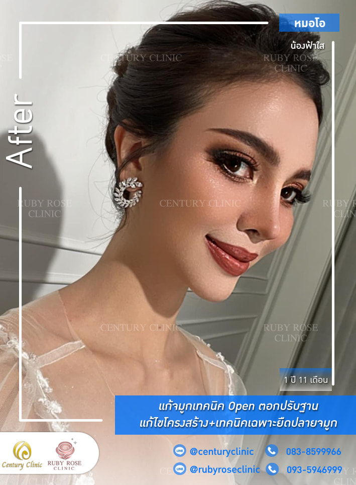 Century-รีวิว-แก้จมูก #296