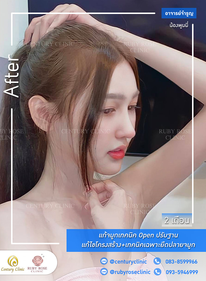 Century-รีวิว-แก้จมูก #297