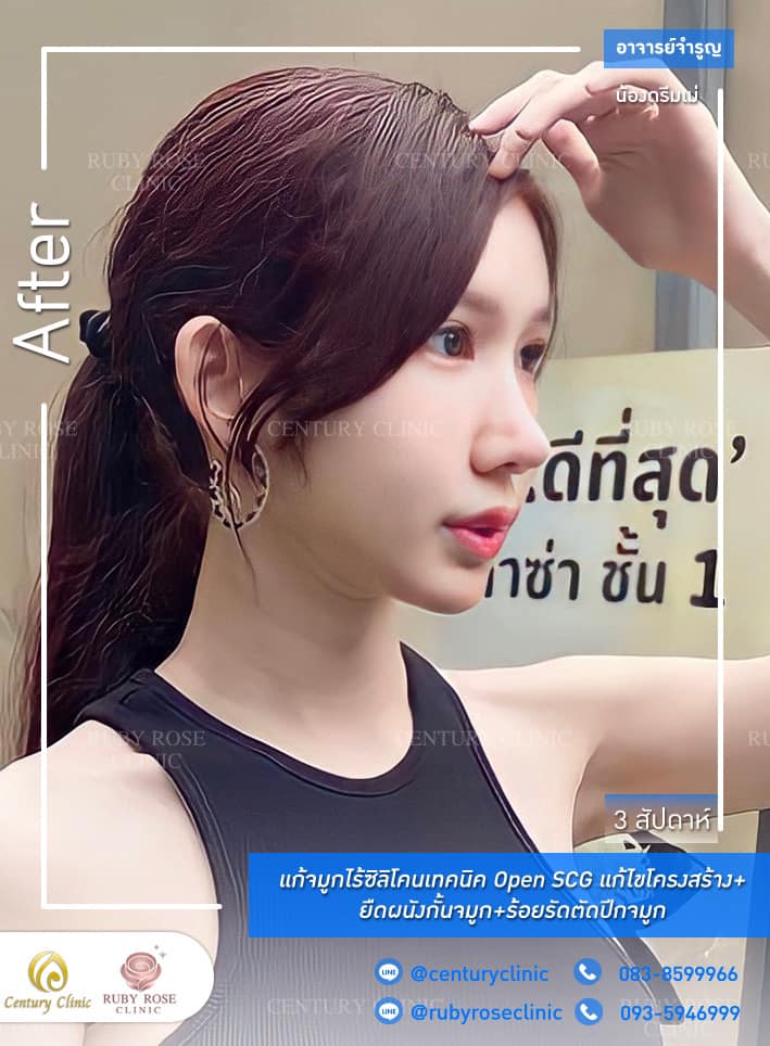 Century-รีวิว-แก้จมูก #302