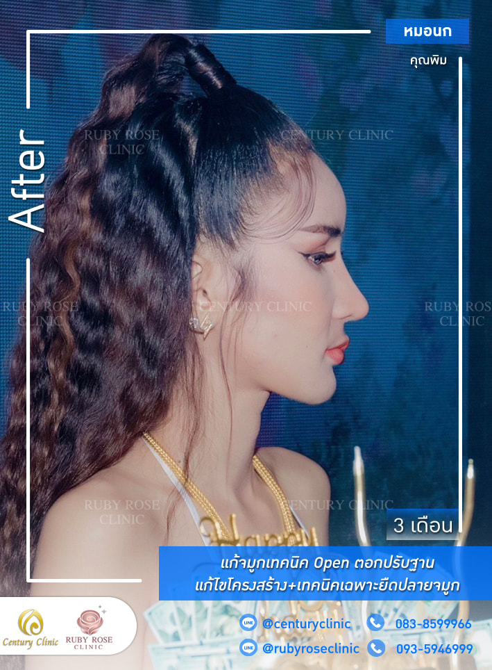 Century-รีวิว-แก้จมูก #303