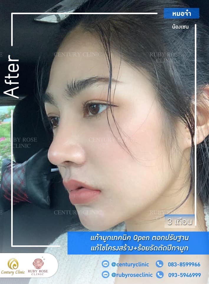 Century-รีวิว-แก้จมูก #308