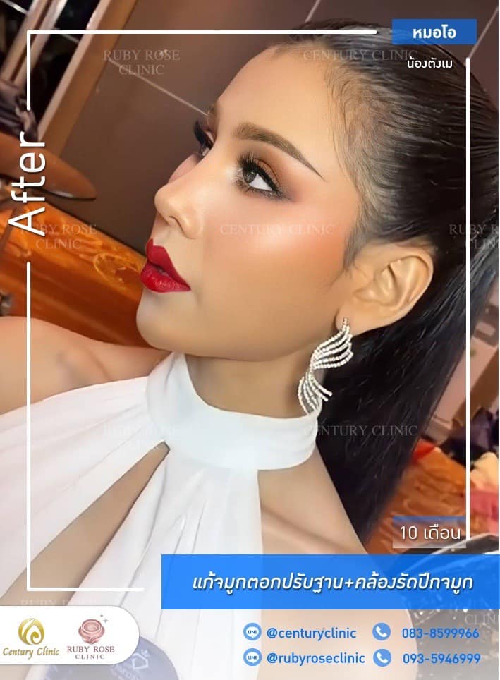 Century-รีวิว-แก้จมูก #311