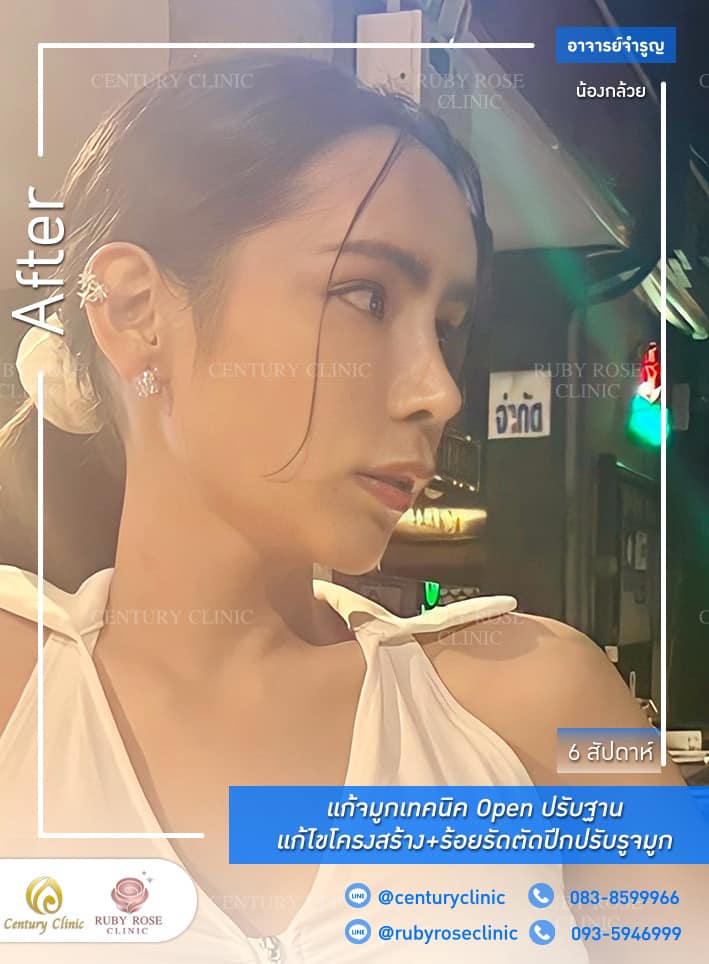 Century-รีวิว-แก้จมูก #312