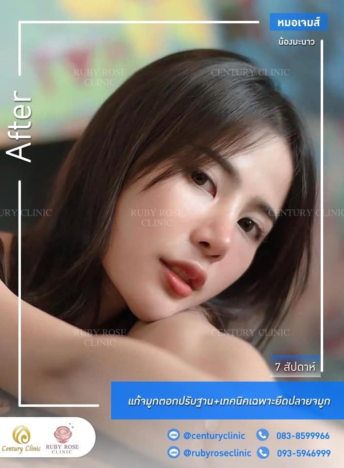 Century-รีวิว-แก้จมูก #314จมูก 2#314