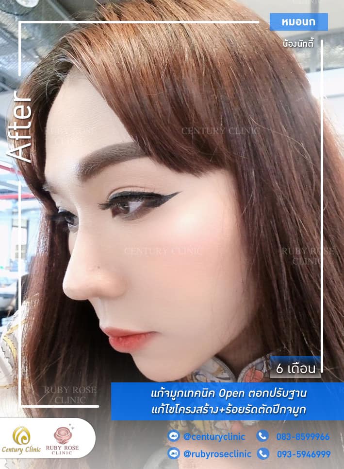 Century-รีวิว-แก้จมูก #316