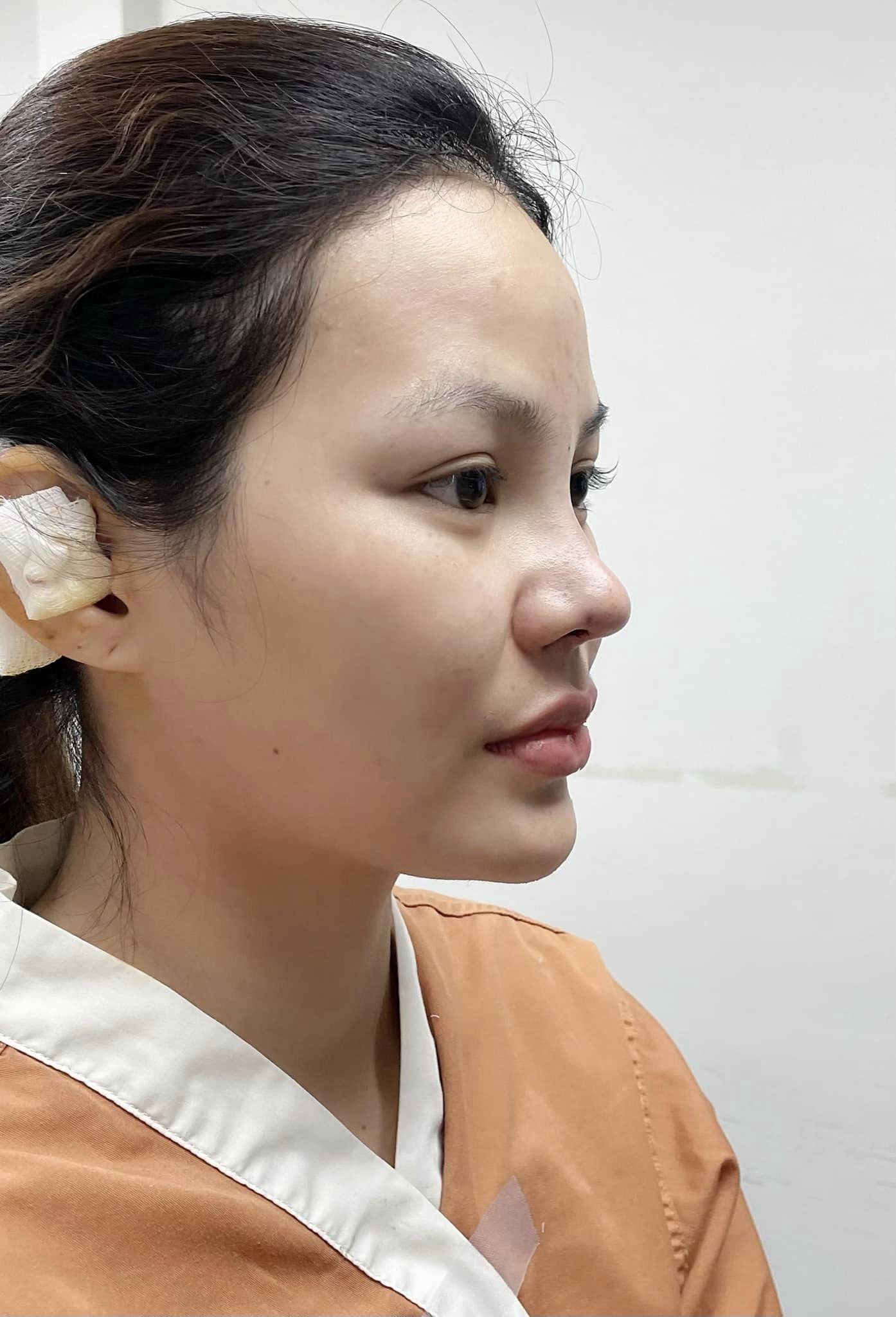 รีวิว แก้จมูก #318 , Century Clinic Thailand Century-รีวิว-แก้จมูก #318