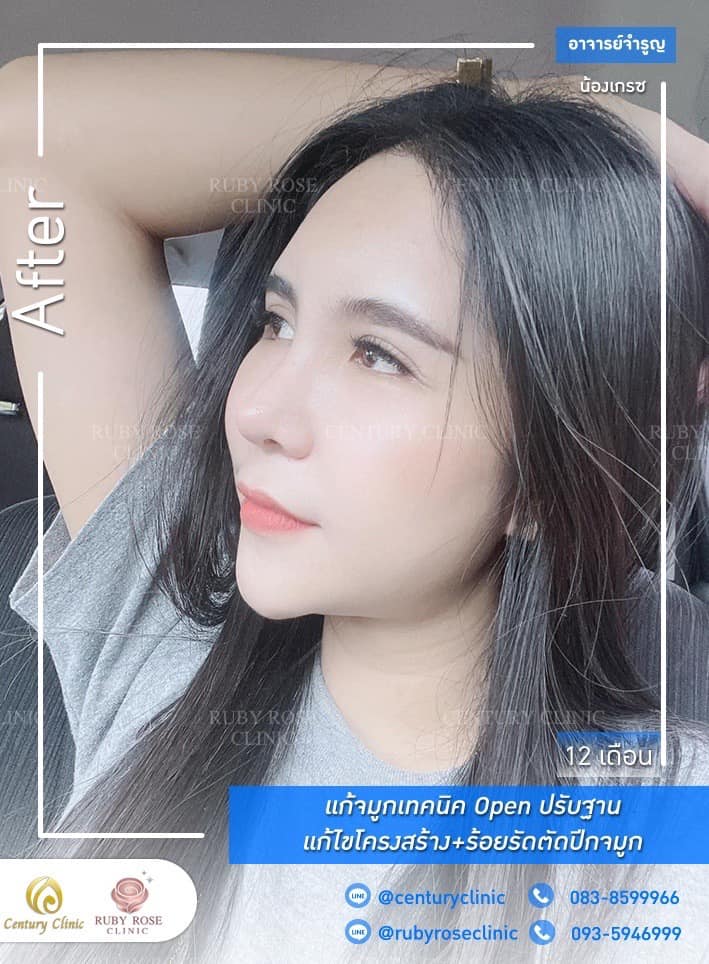 รีวิว แก้จมูก #328 , Century Clinic Thailand Century-รีวิว-แก้จมูก #328