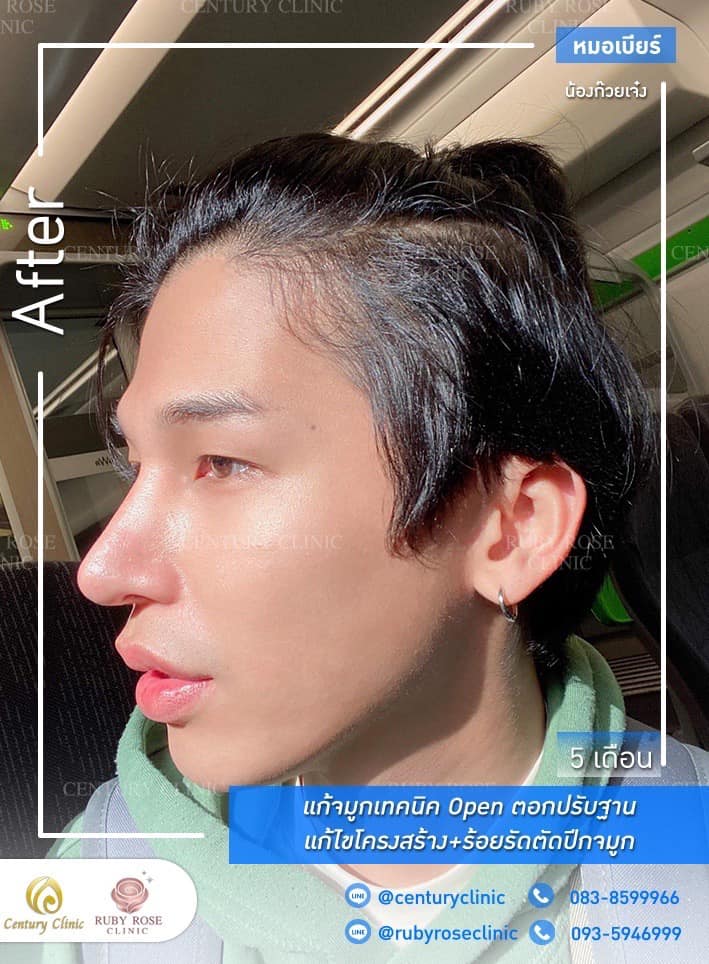 รีวิว แก้จมูก #330 , Century Clinic Thailand Century-รีวิว-แก้จมูก #330