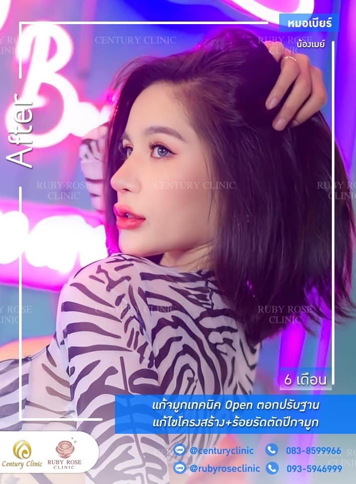 รีวิว แก้จมูก #332 , Century Clinic Thailand Century-รีวิว-แก้จมูก #332
