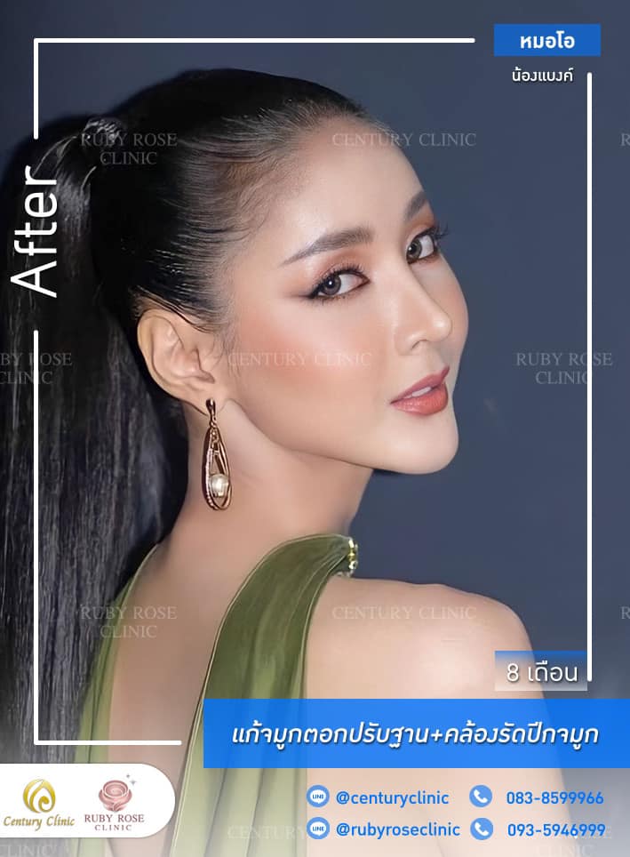 รีวิว แก้จมูก #333 , Century Clinic Thailand Century Clinic Thailand