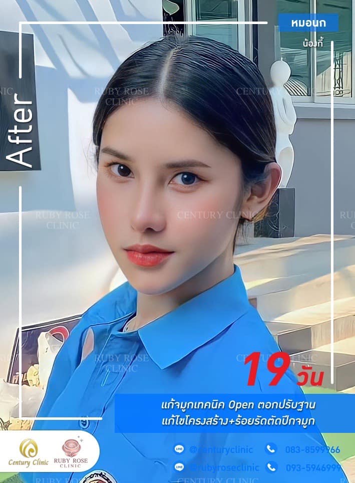 รีวิว แก้จมูก #334 , Century Clinic Thailand Century-รีวิว-แก้จมูก #334