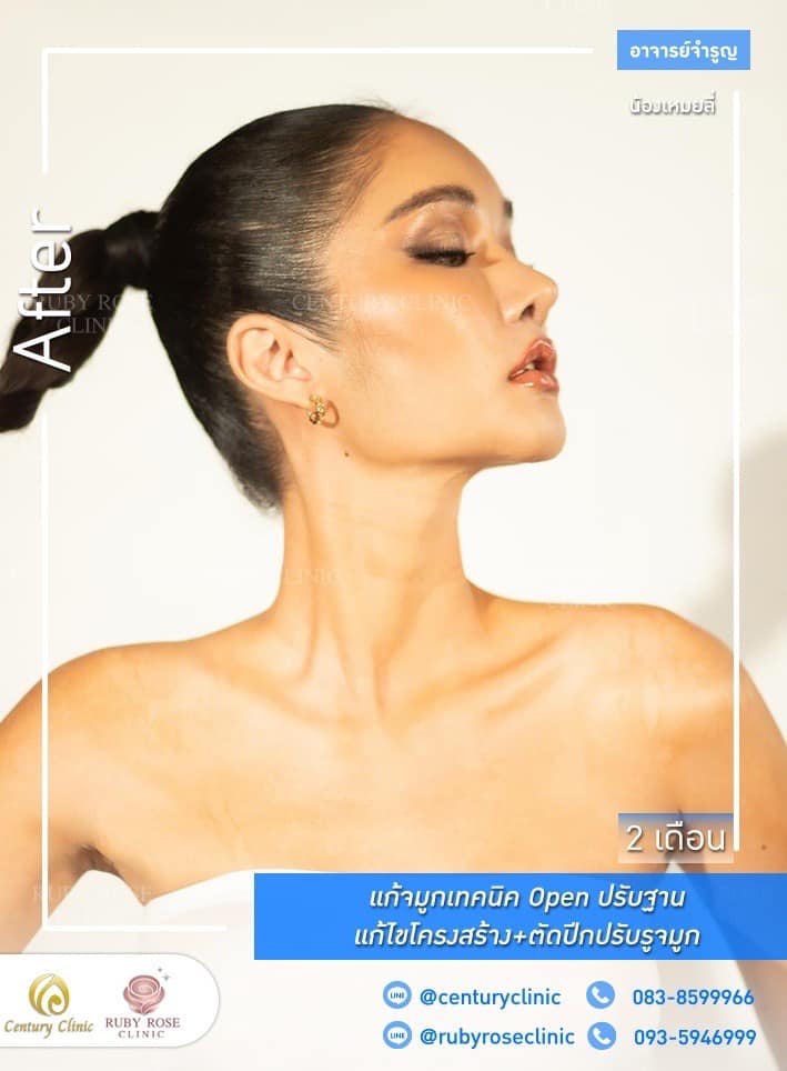 Century-รีวิว-แก้จมูก #335