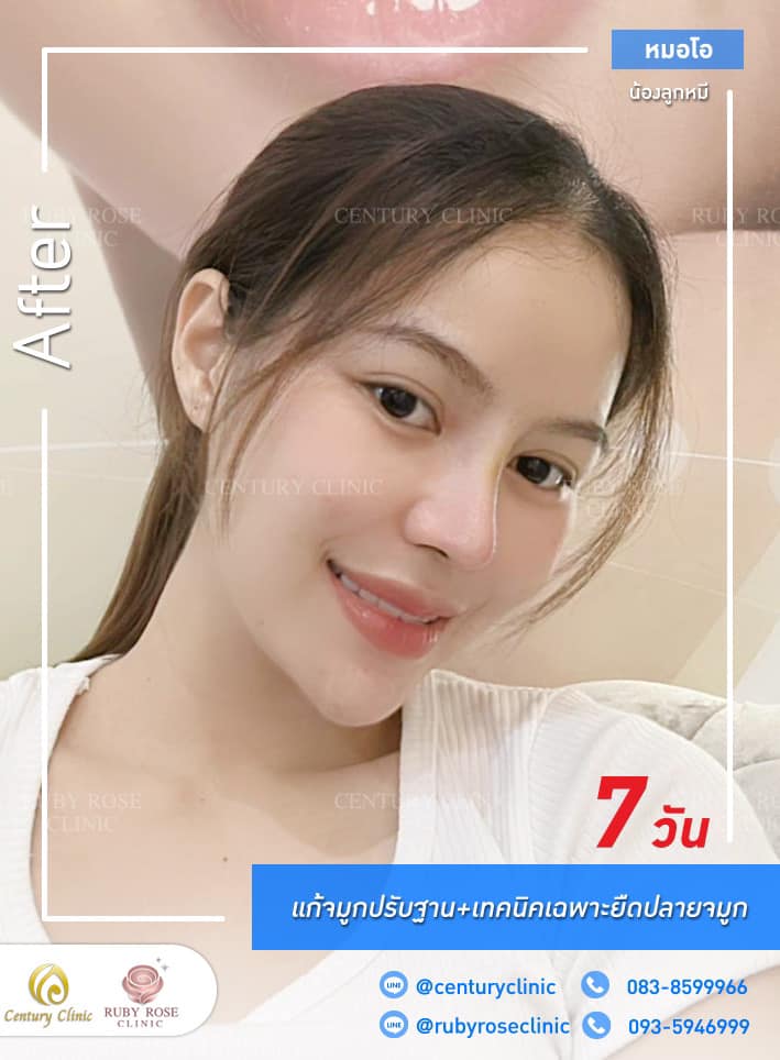 Century-รีวิว-แก้จมูก #338