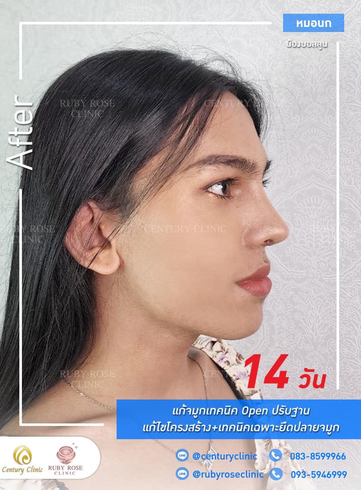 Century-รีวิว-แก้จมูก #339