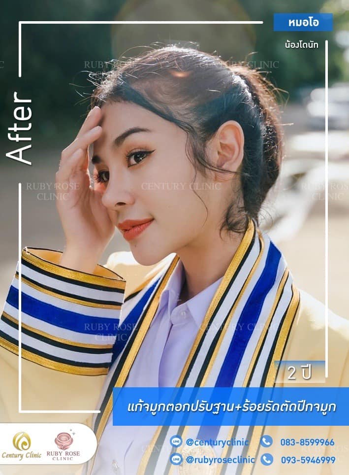 Century-รีวิว-แก้จมูก #341
