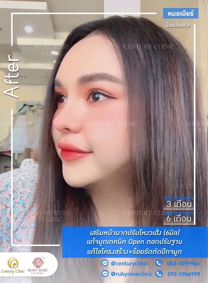 Century-รีวิว-แก้จมูก #342