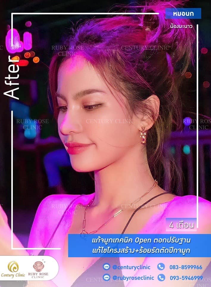 รีวิว แก้จมูก #343