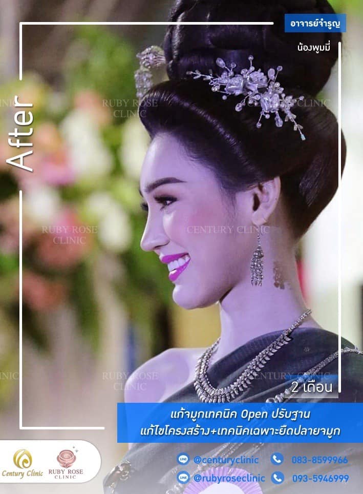Century-รีวิว-แก้จมูก #344