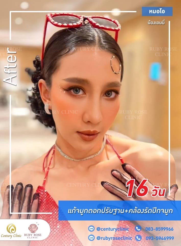 รีวิว แก้จมูก #345 , Century Clinic Thailand Century-รีวิว-แก้จมูก #345