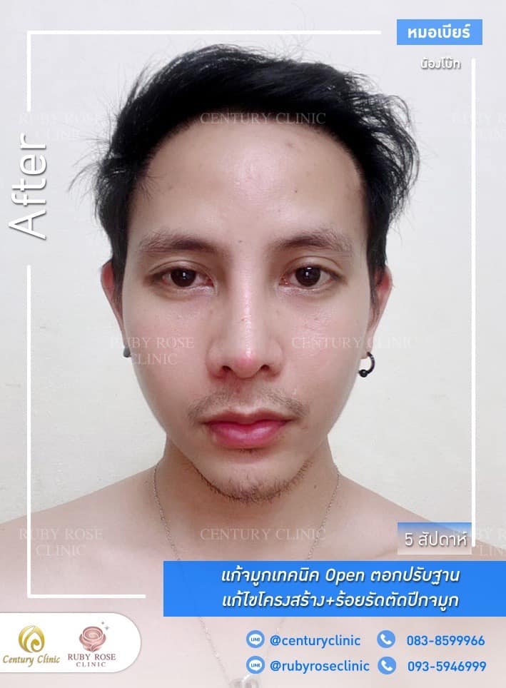 รีวิว แก้จมูก #346 , Century Clinic Thailand Century-รีวิว-แก้จมูก #346