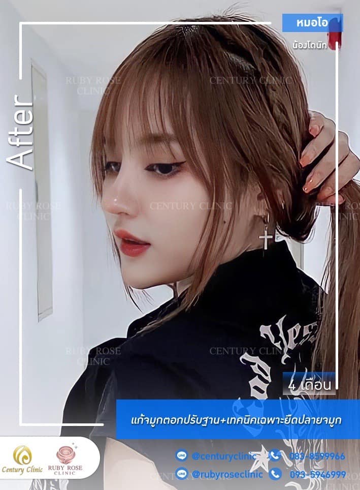 Century-รีวิว-แก้จมูก #349