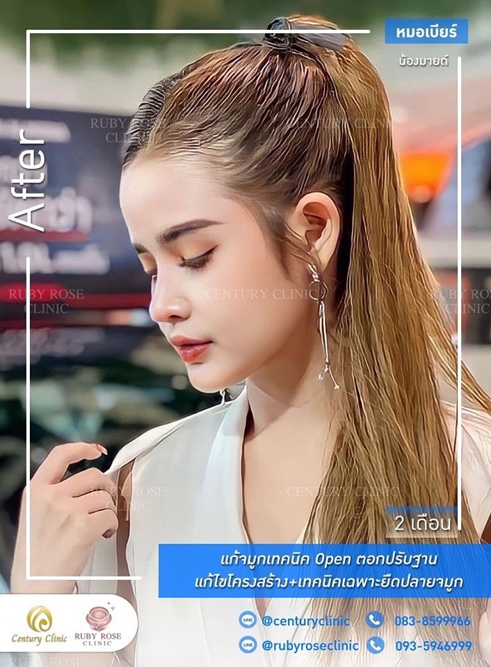 Century-รีวิว-แก้จมูก #351