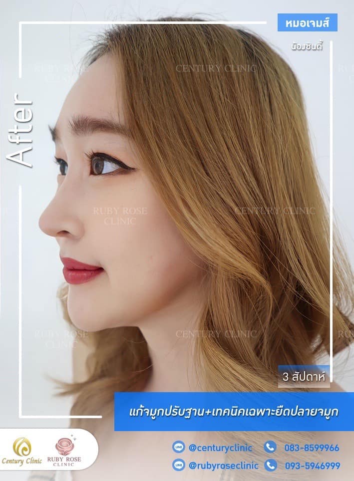 รีวิว แก้จมูก #352 , Century Clinic Thailand Century-รีวิว-แก้จมูก #352
