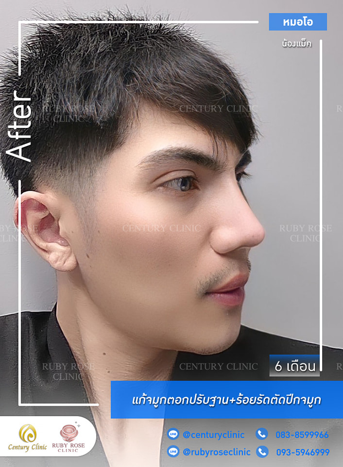 รีวิว แก้จมูก #353 , Century Clinic Thailand Century-รีวิว-แก้จมูก #353