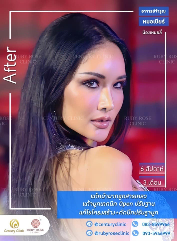 Century-รีวิว-แก้จมูก #358