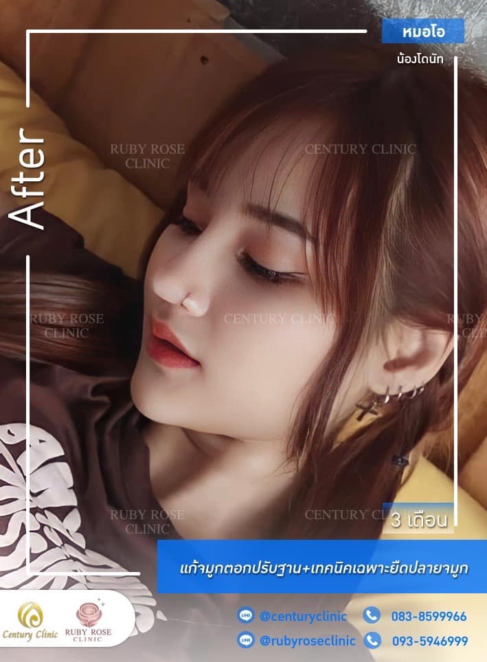 Century แก้จมูก 1#288