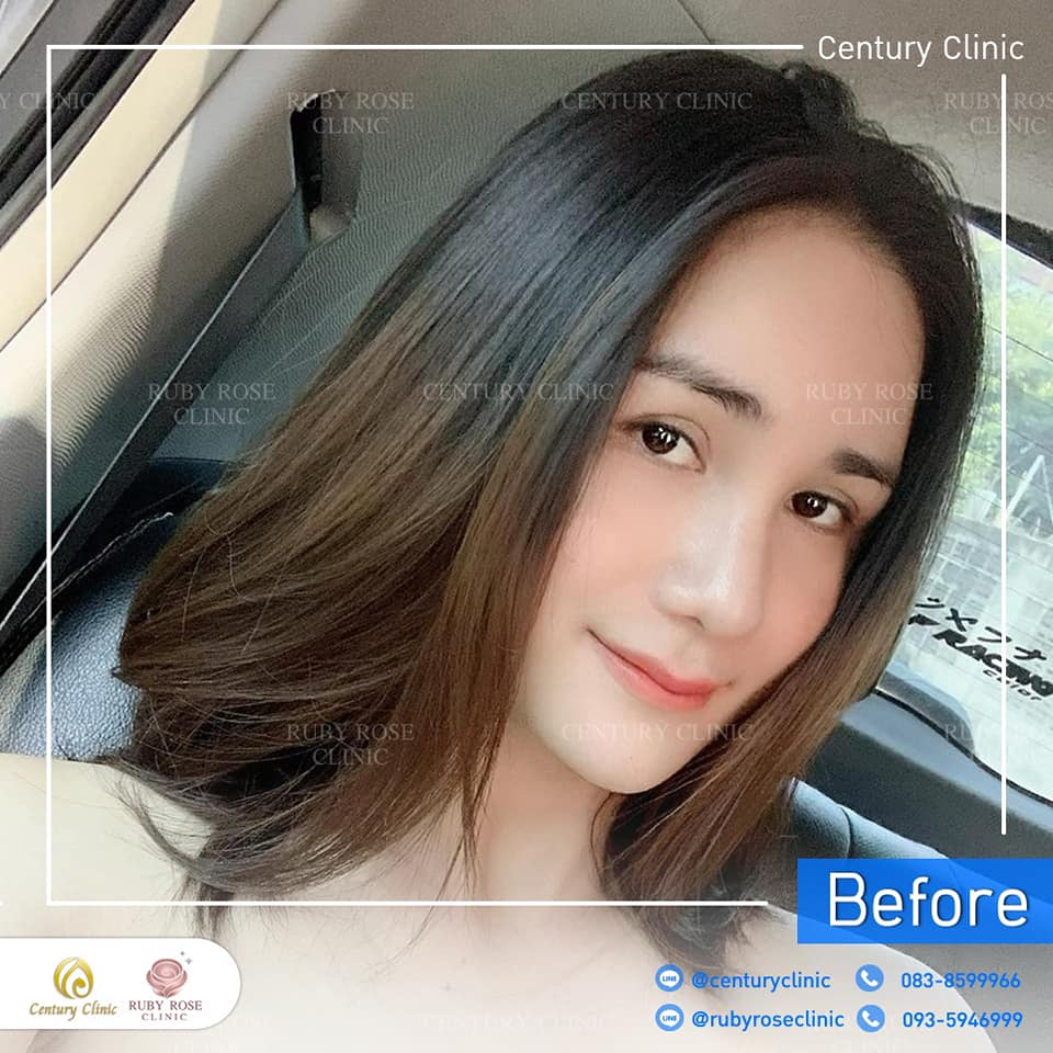 Century แก้จมูก 1#290