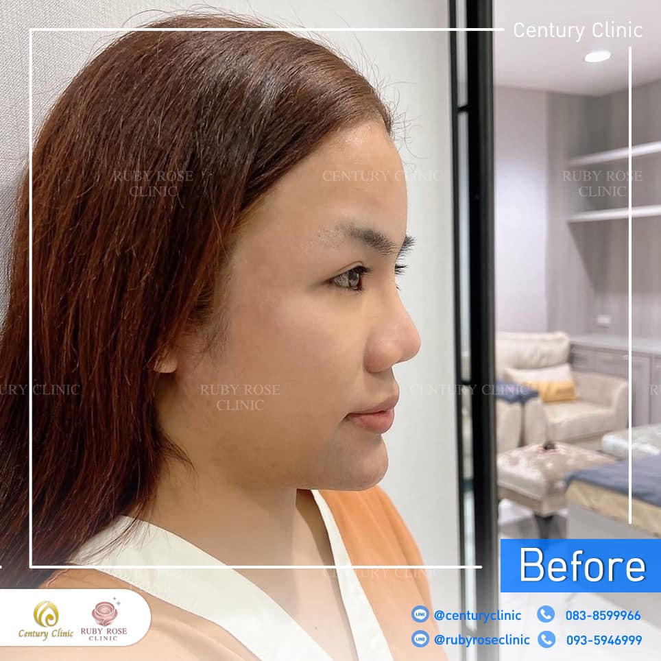 รีวิว แก้จมูก #289 , Century Clinic Thailand Century Clinic Thailand