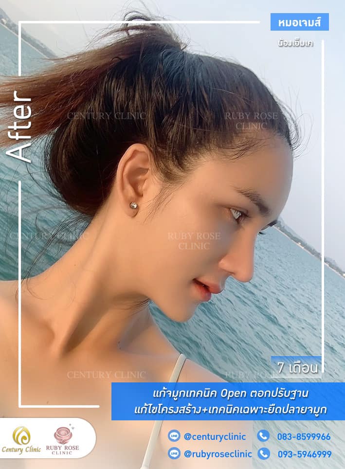 Century แก้จมูก #290