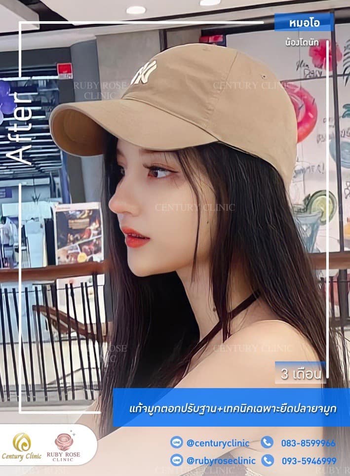 Centuryรีวิว แก้จมูก#288