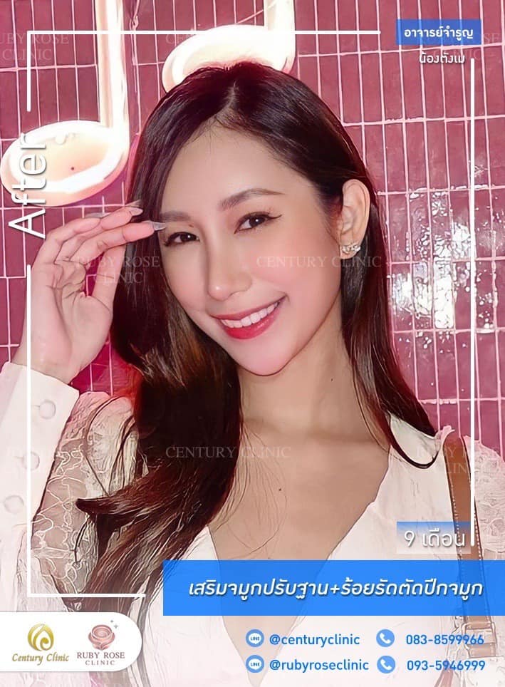 Century-รีวิว-เสริมจมูก 1#364